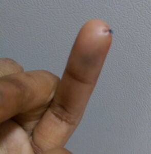 Finger with a single stitch.