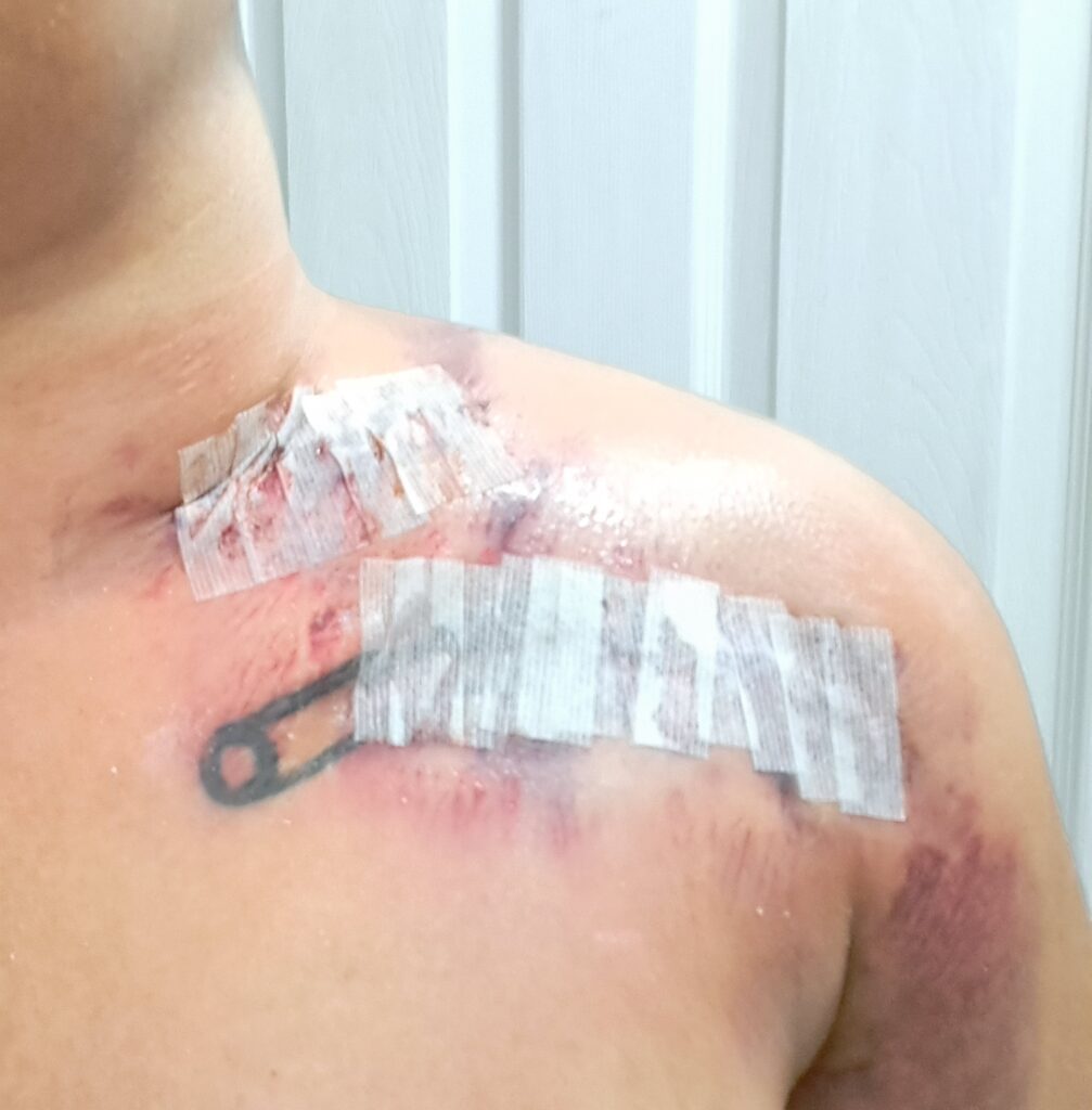Steri-Strips covering two incisions on the left upper extremity.