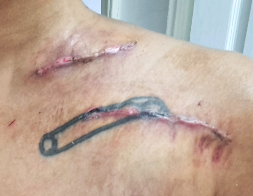 Raised scars on the left side of my neck, crossing through a safety pin tattoo.